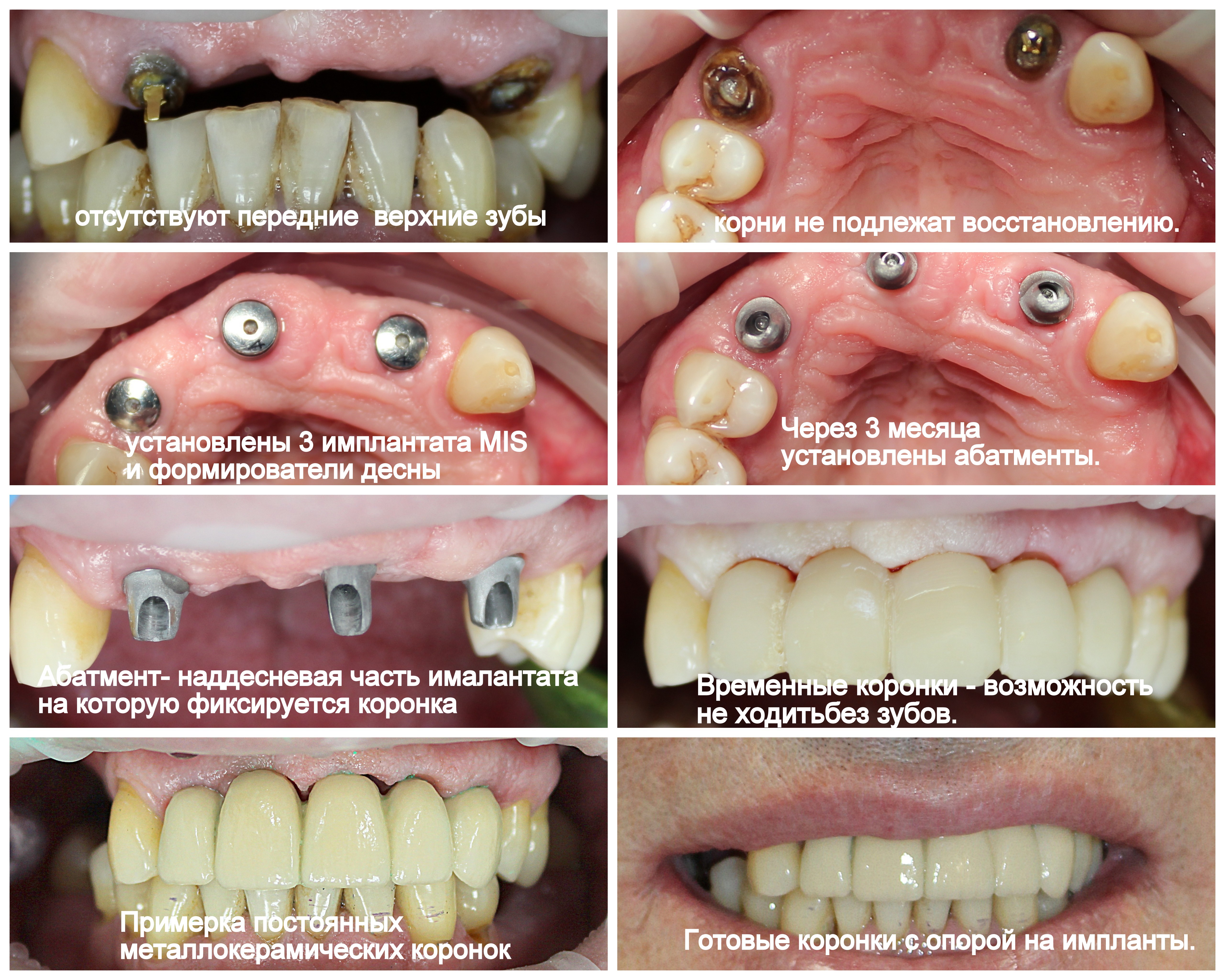 Протезирование передних зубов. Имплантация.