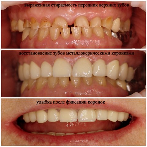 Восстановление передних зубов металлокерамическими коронками