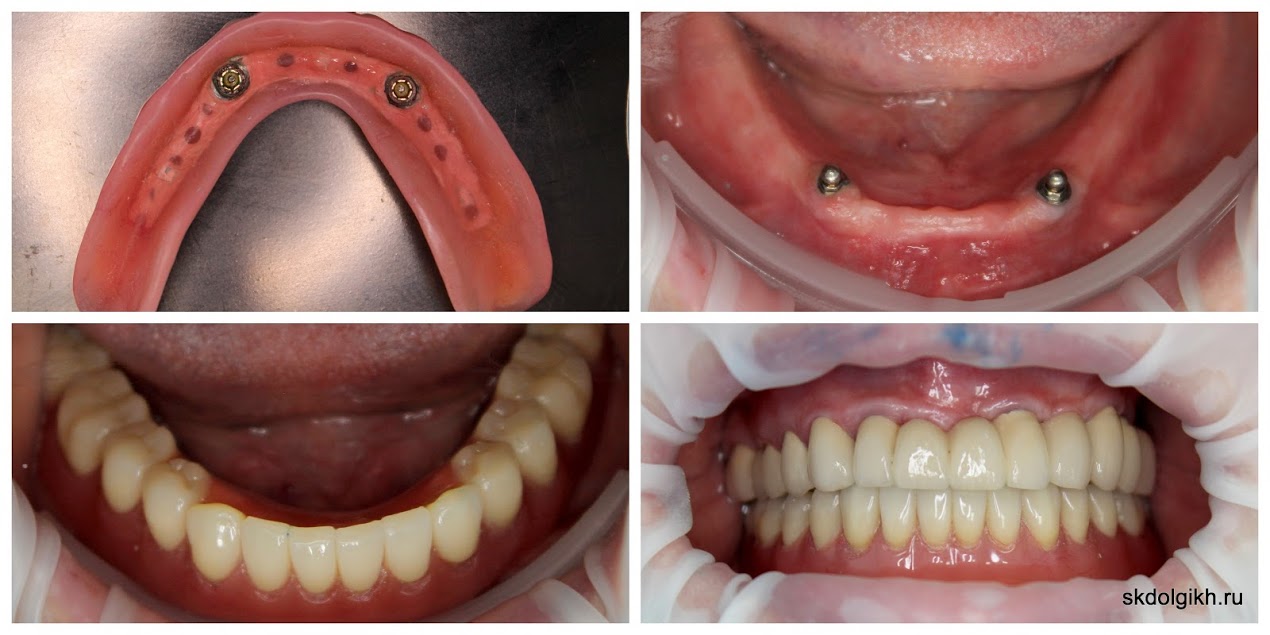 Протезирование с опорой на дентальные импланты при полном отсутствии зубов