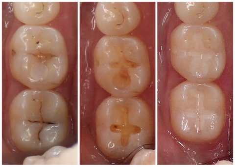 Лечение кариеса жевательных зубов